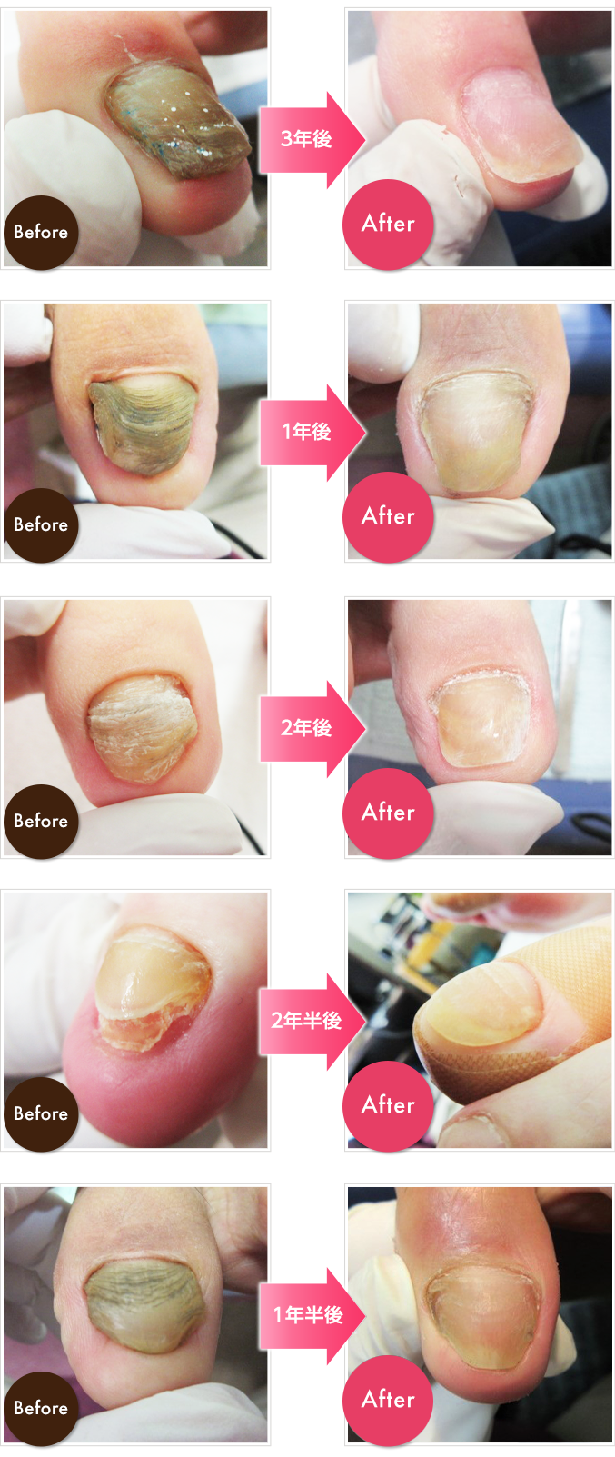 nail-restore-3b.png